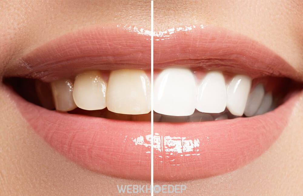 Thời gian giữ màu có thể kéo dài hơn nhờ công nghệ tẩy trắng răng hiện đại