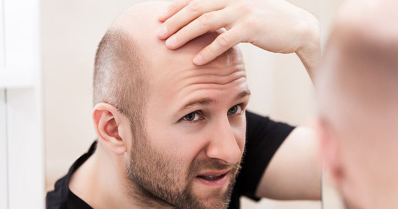 9 nguyên nhân gây rụng tóc ở nam giới và 10 cách kích thích mọc nhanh