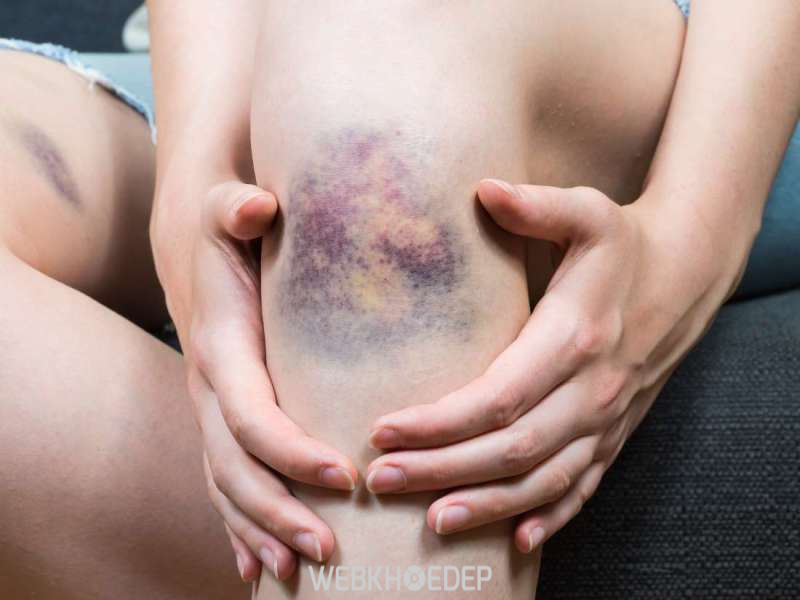 Bầm tím dưới da là một trong những dấu hiệu của bệnh bạch cầu cấp (Nguồn: verywellhealth.com)