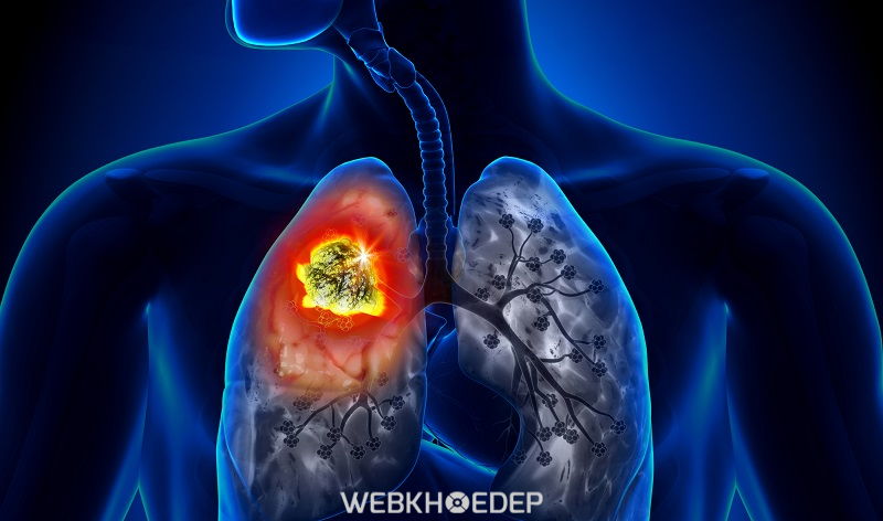 Ung thư phổi là loại ung thư phổ biến ở độ tuổi ngoài 40 