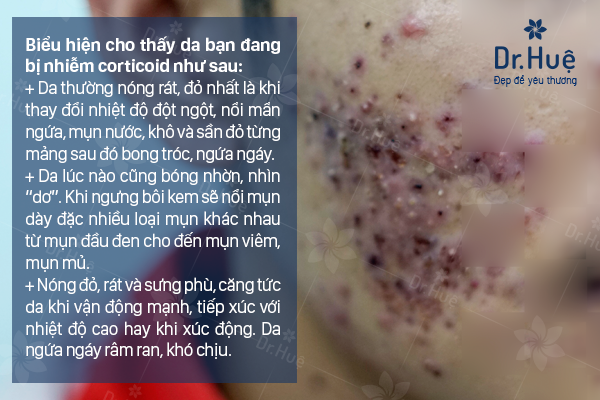Biểu hiện khi da bị nhiễm Corticoid