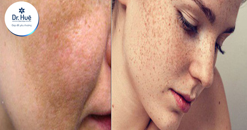 Độ tuổi bị nám da mặt thường nằm trong khoảng nào