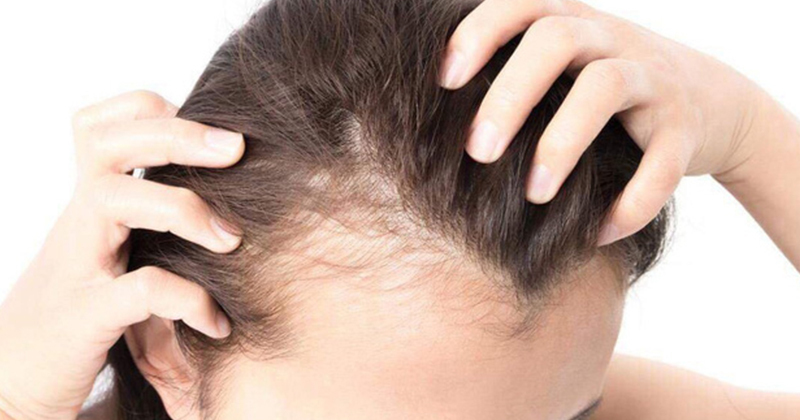Hói đầu có chữa được không? 5 cách giảm rụng tóc khoa học an toàn
