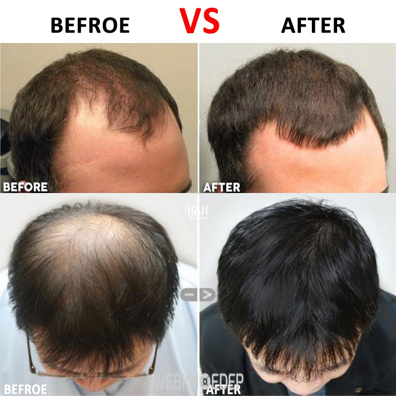 Rụng tóc mất kiểm soát dẫn tới tình trạng hói đầu
