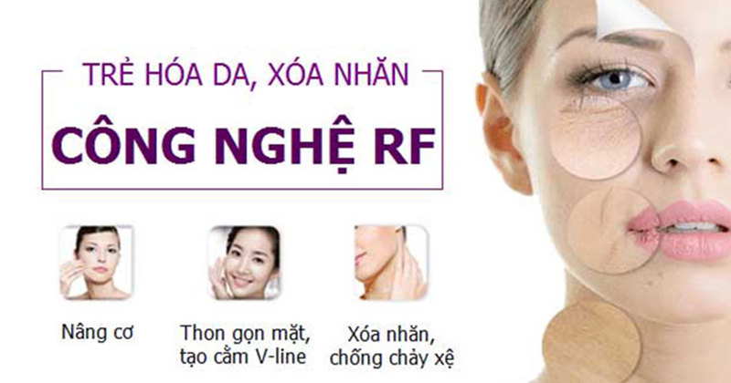 Nâng cơ mặt bằng sóng RF là gì, giá bao nhiêu, liệu trình như thế nào?