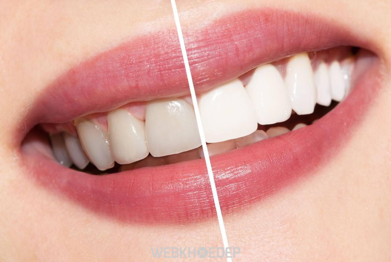 Kết quả của phương pháp tẩy trắng răng có duy trì lâu dài hay không phụ thuộc vào nhiều yếu tố 