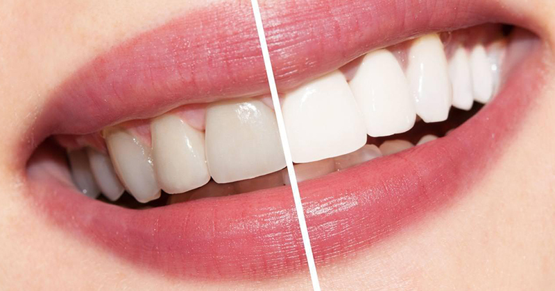 Tẩy trắng răng được bao lâu thì trắng và hết đau, chọn nha khoa nào