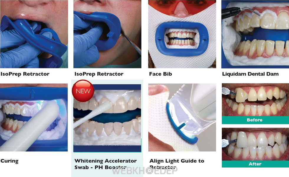 Tẩy trắng răng Laser Whitening mang lại hiệu quả cao