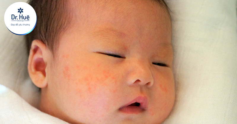 Trẻ sơ sinh nổi mụn trên mặt nên xử lý như thế nào