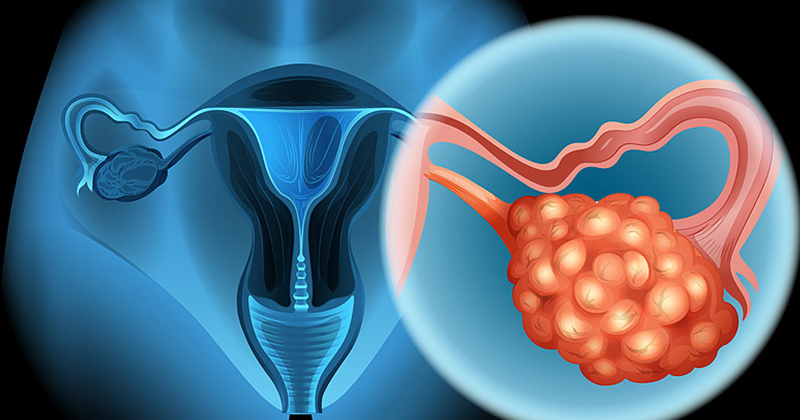 Ung thư buồng trứng giai đoạn đầu: Dấu hiệu, Tiên lượng, Cách chữa