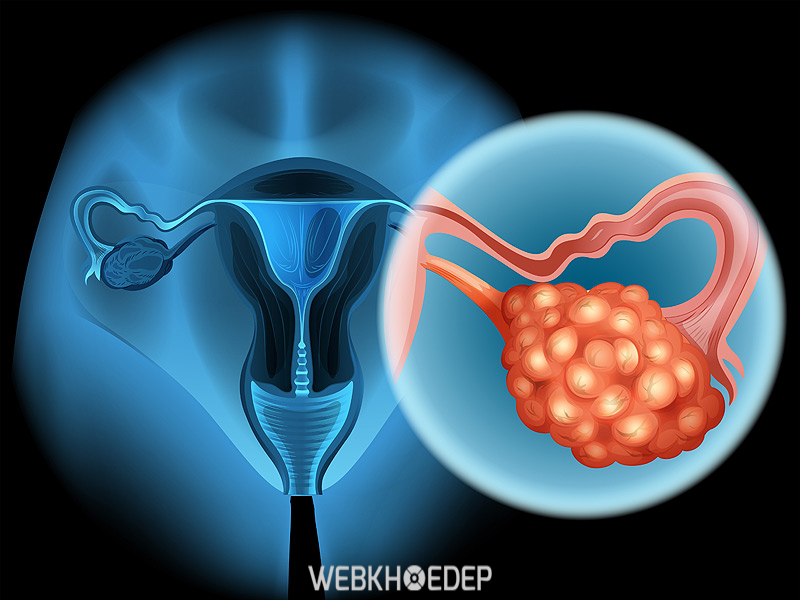Ung thư buồng trứng tại giai đoạn đầu có thể chữa khỏi được không?