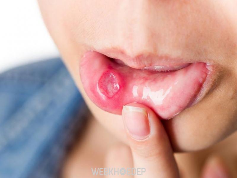 Lở miệng gây khó chịu cho người bệnh khi điều trị bằng hóa trị, xạ trị