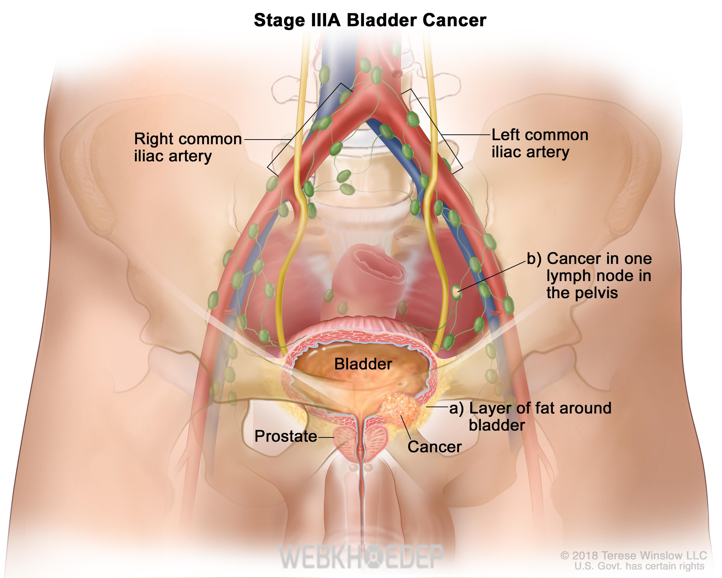 Ung thư tuyến tiền liệt ở giai đoạn 3 - khối u đã phát triển lớn 